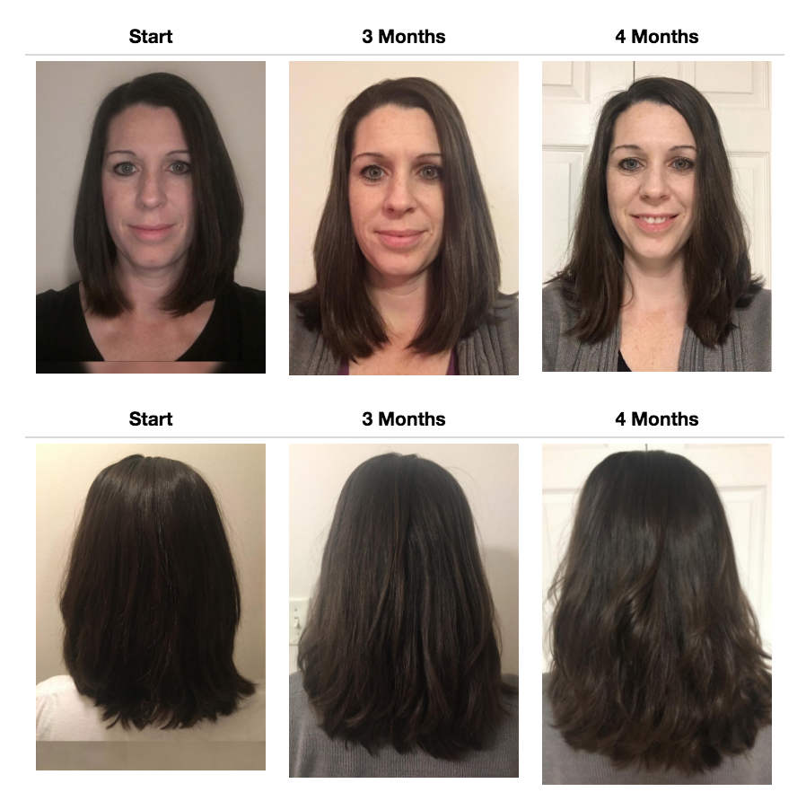 UP Hair Growth System stops hair loss & creates fast new growth