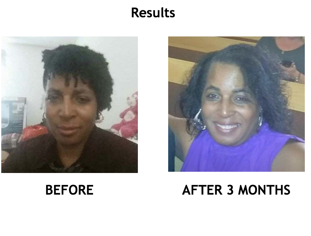 UP Hair Growth System stops hair loss & creates fast new growth